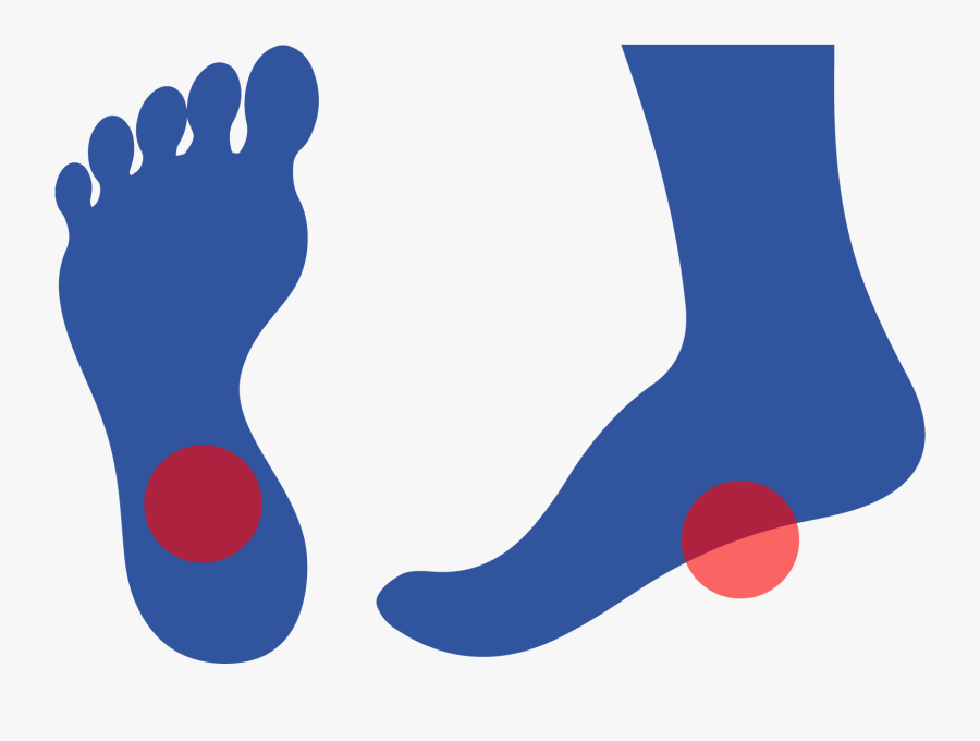 Plantar Fasciitis Is Caused By Inflammation Of A Thick, Transparent Clipart