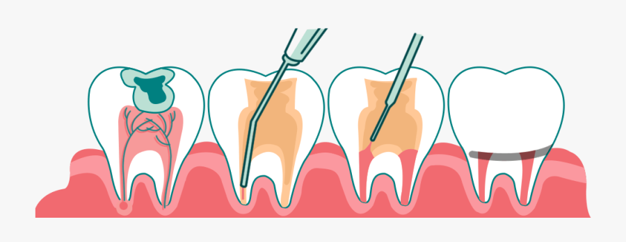Root Canal Treatment For Kids, Transparent Clipart