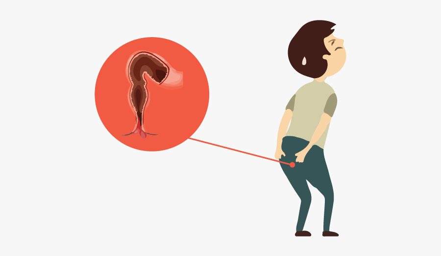 Prolapse Of Rectum, Transparent Clipart