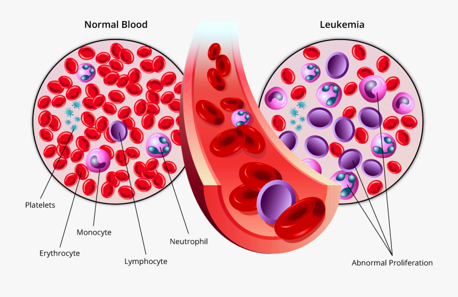 Acute Myeloid Leukemia Aml, Transparent Clipart