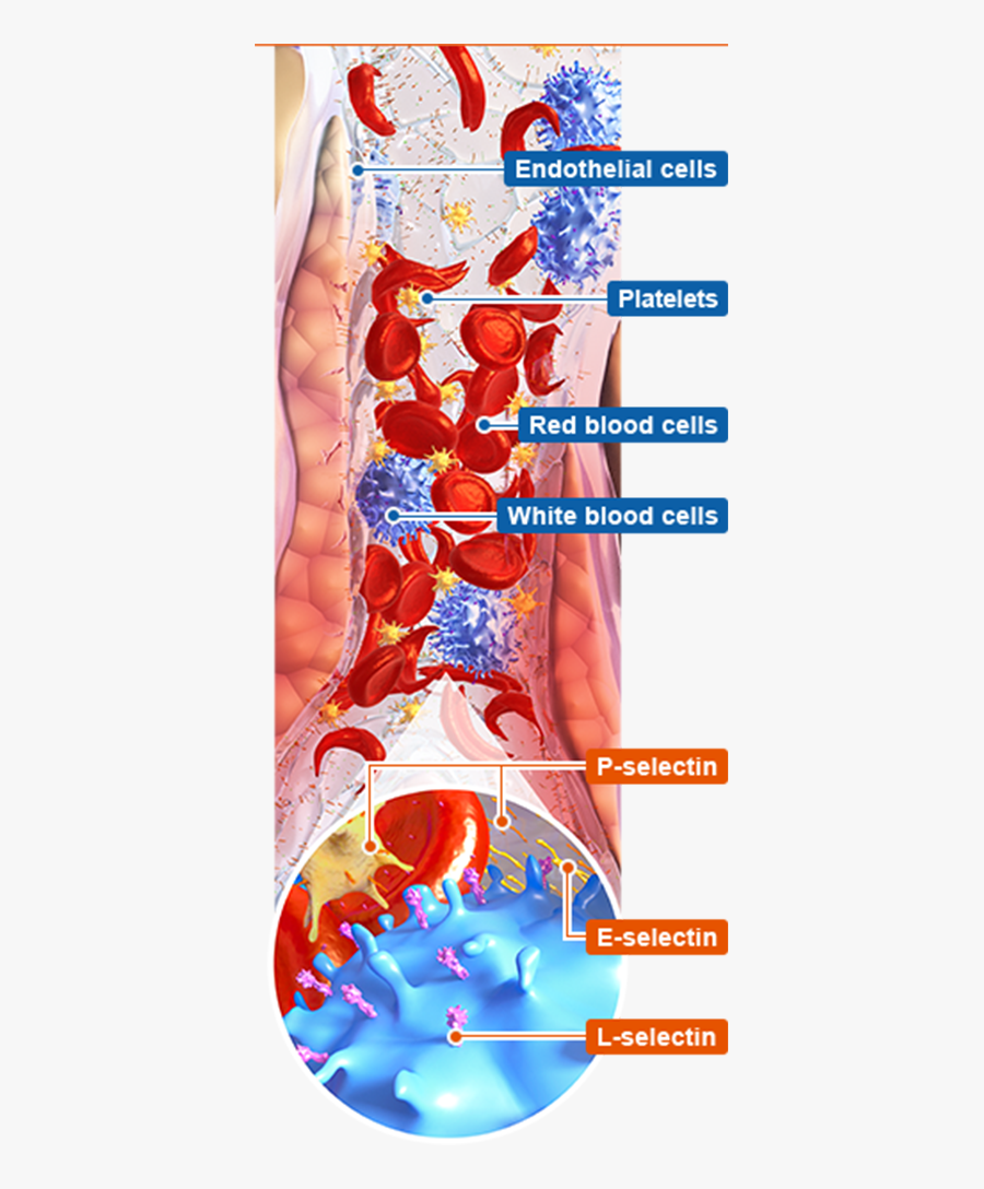 Vaso-occlusive Crises - Medical Imaging, Transparent Clipart