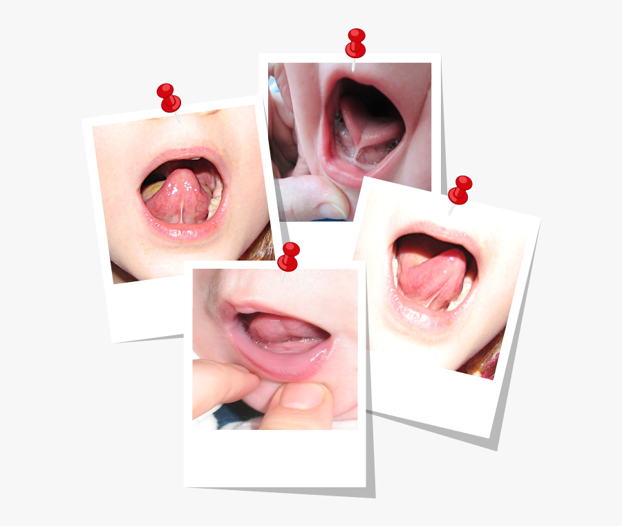 Tongue Clip Lingual Frenulum - Tongue, Transparent Clipart
