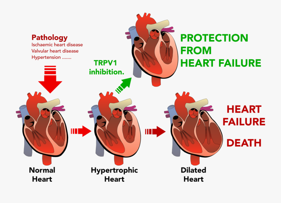 Disease Clipart Heart Failure - Heart Disease Progression, Transparent Clipart