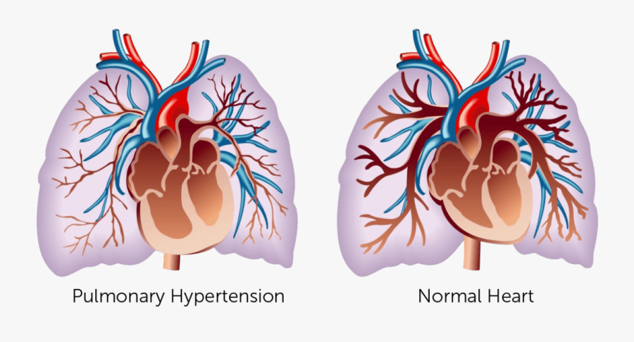Pulmonary Hypertension Center - Pulmonary Hypertension Disease, Transparent Clipart