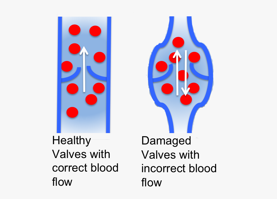 Normal And Distended Valves, Transparent Clipart