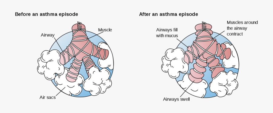 Bronchial Asthma, Transparent Clipart