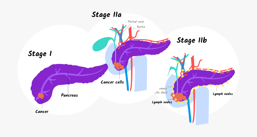 Illustration Of Stage I And Stage Iia And Iib Pancreatic - Stage 1 Early Stage Pancreatic Cancer, Transparent Clipart