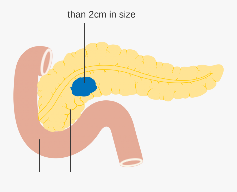 Pancreatic Cancer Png, Transparent Clipart