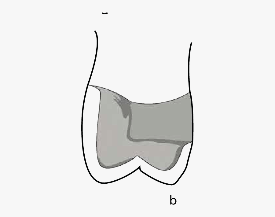 Coping Design For A Metal-ceramic Restoration With - Supported Porcelain Coping Design, Transparent Clipart