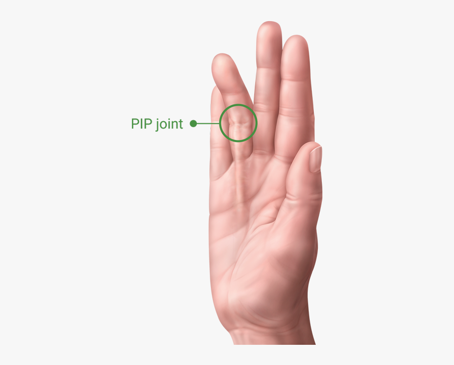 A Hand With Dupuytren’s Contracture Showing The Pip - Dupuytren's Contracture, Transparent Clipart