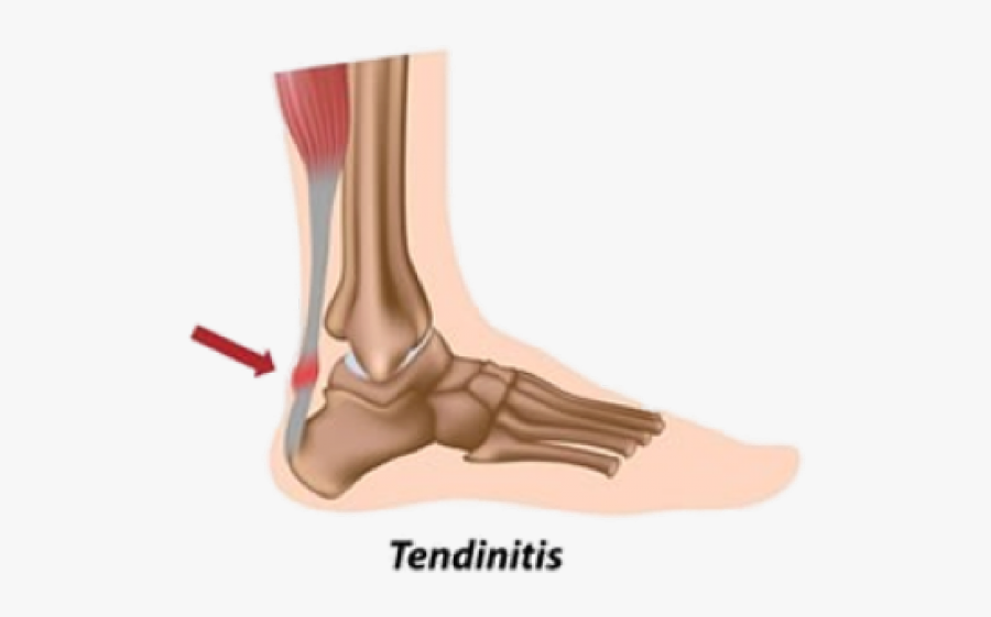 Achilles Tendon Pain, Transparent Clipart