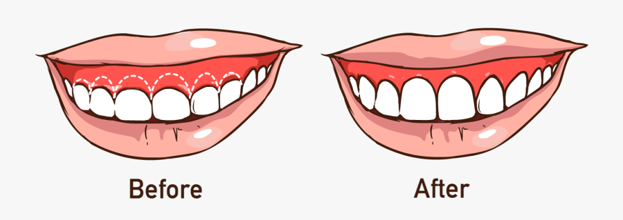 Advanced Dental Care - Frenectomy Gummy Smile, Transparent Clipart