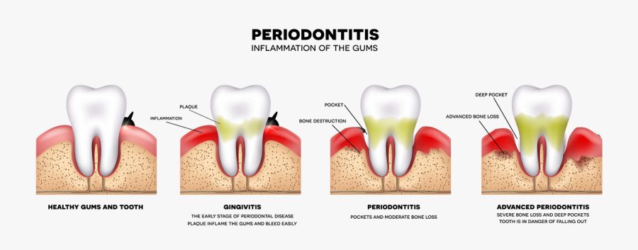 Gum Drawing Gingivitis - Periodontal Disease, Transparent Clipart