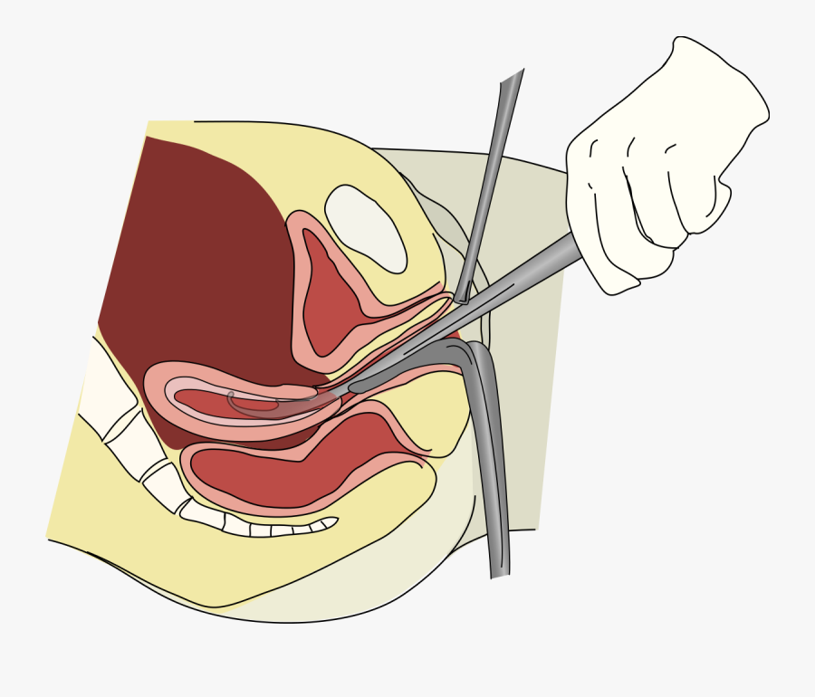 Dilation And Curettage - Whats In A Rape Kit, Transparent Clipart