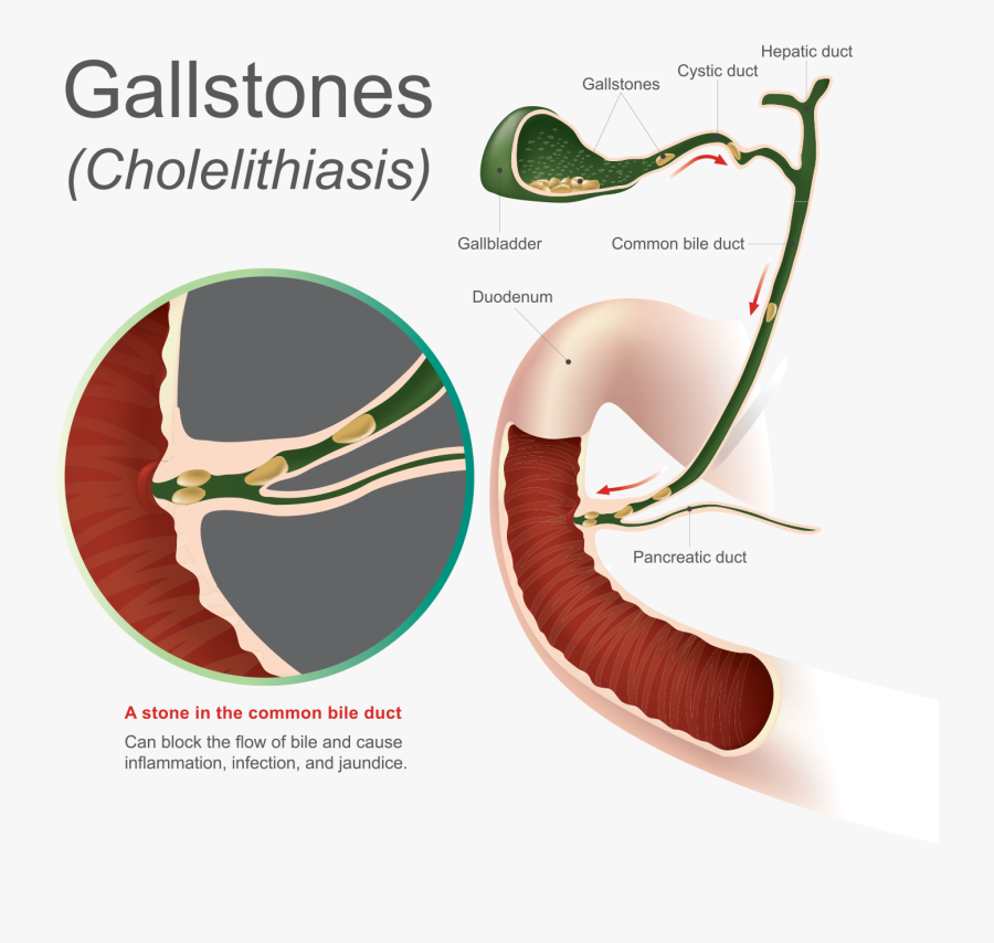 Liver Clipart Gallbladder - Explored Common Bile Duc, Transparent Clipart