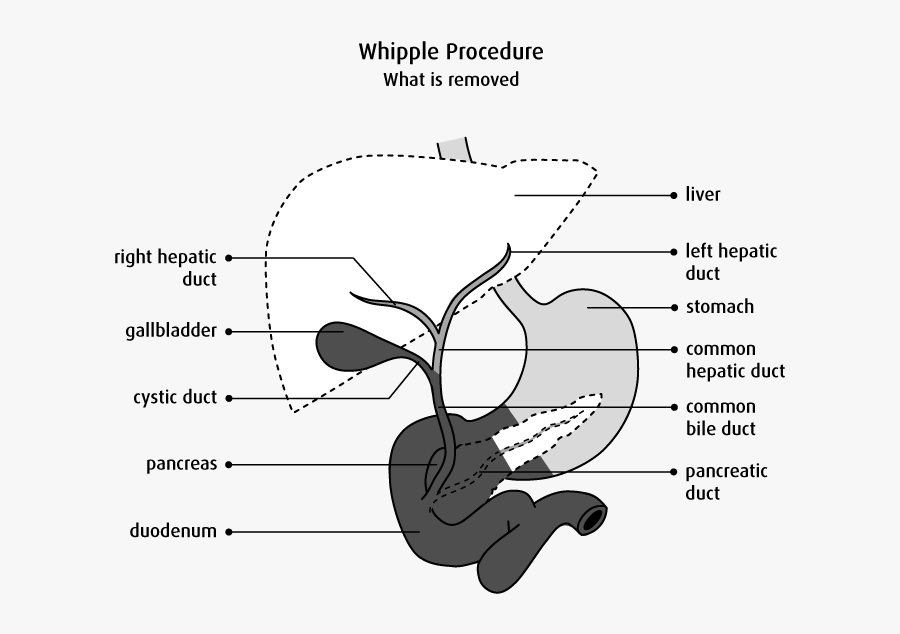 Diagram Of What Is Removed In A Whipple Procedure - Pancreatic Cancer Palliative Surgery, Transparent Clipart