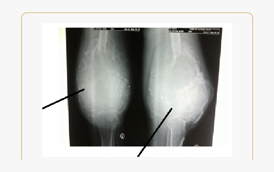 Ap And Lateral Radiographs Of The Left Knee Joint - Medical Radiography, Transparent Clipart