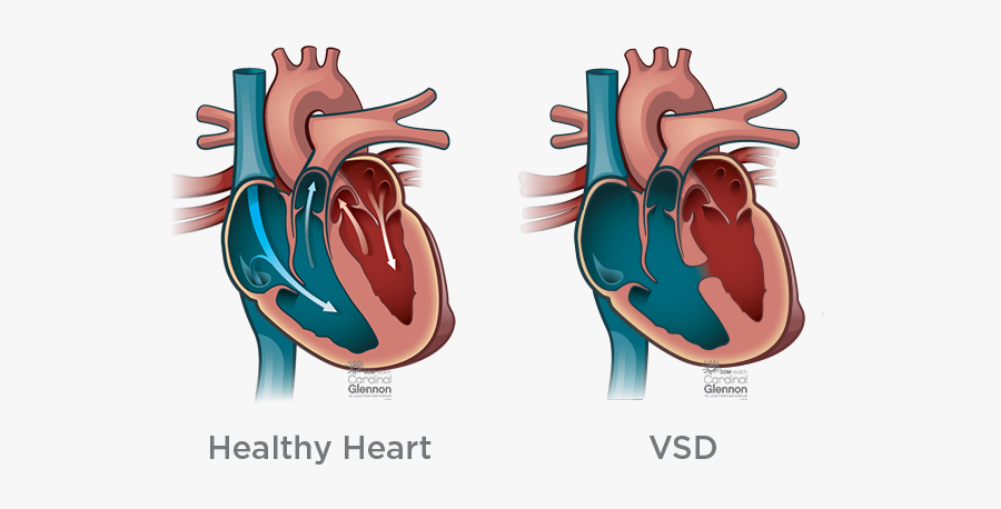 Side By Side Vsd - Children’s Healthcare Of Atlanta, Transparent Clipart
