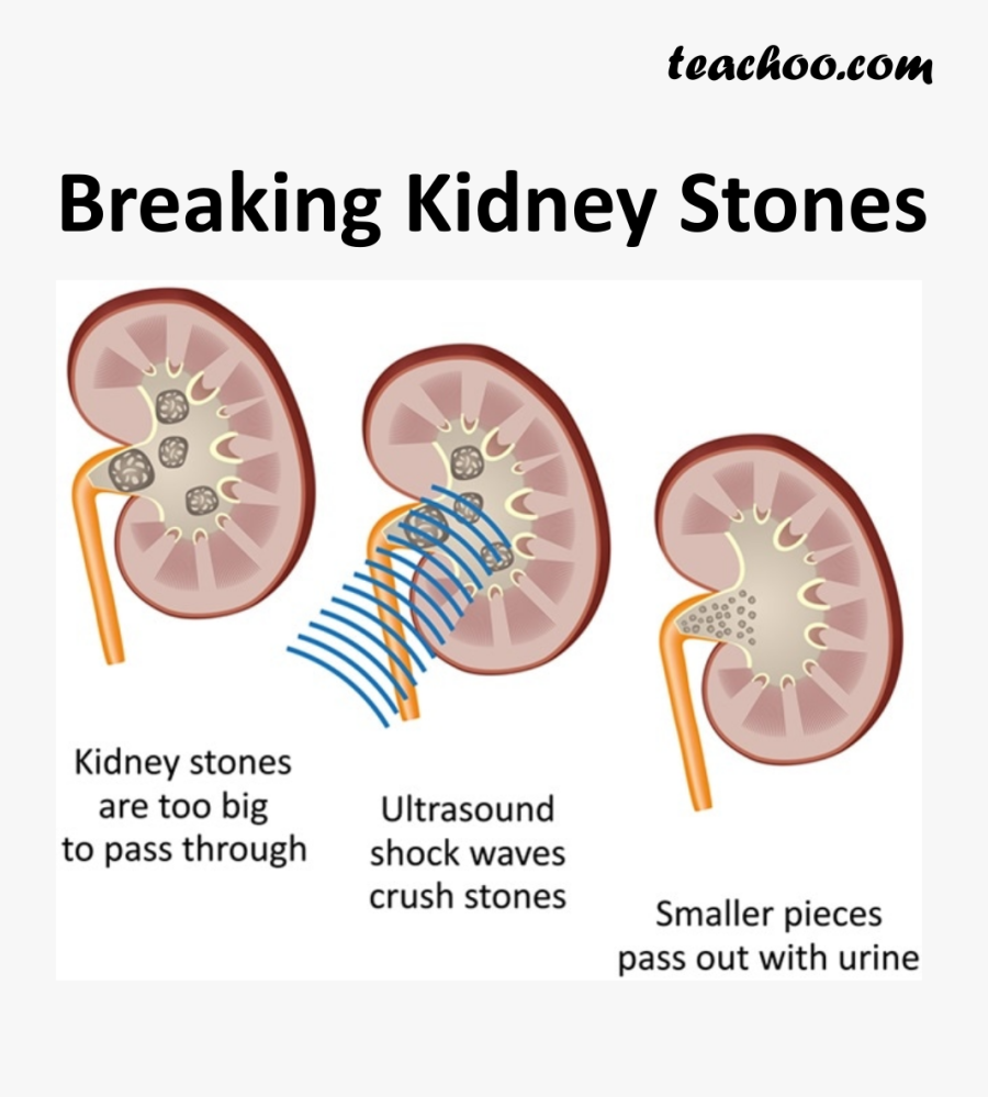 Breaking Kidney Stones - Treat Kidney Stones, Transparent Clipart