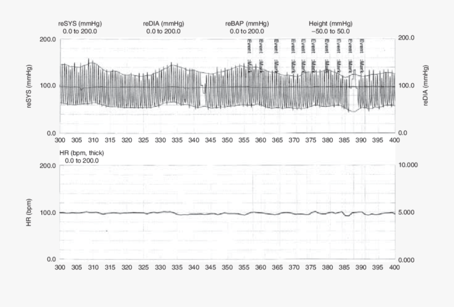 Absent Heart Rate Response To Controlled Deep Breathing - Paper, Transparent Clipart