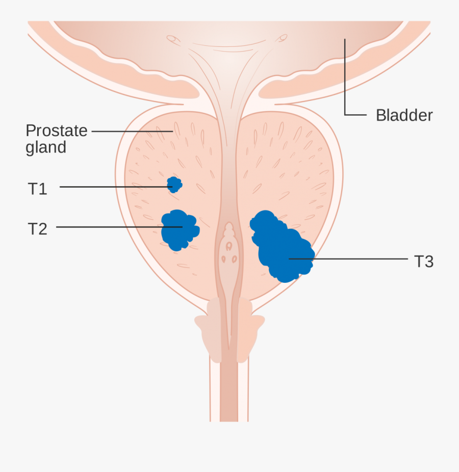 Prostate Cancer Affects Almost A Quarter Of A Million - Illustration, Transparent Clipart