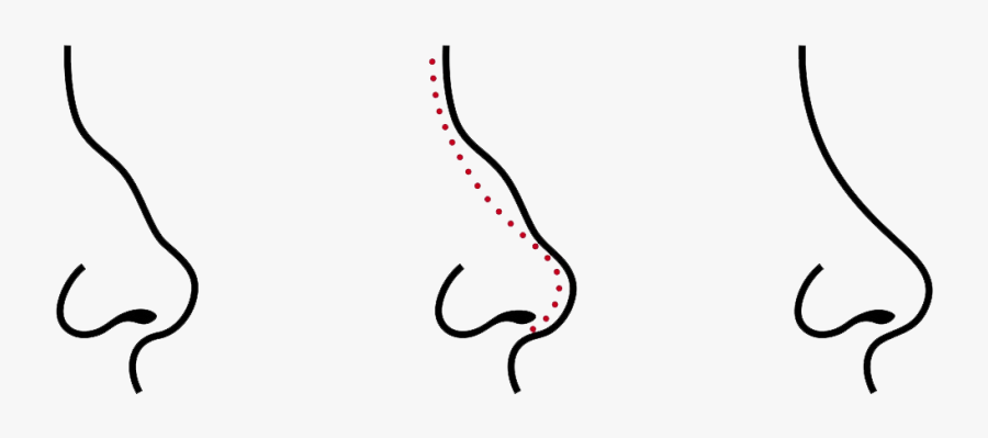 Rhinoplasty Drawing, Transparent Clipart