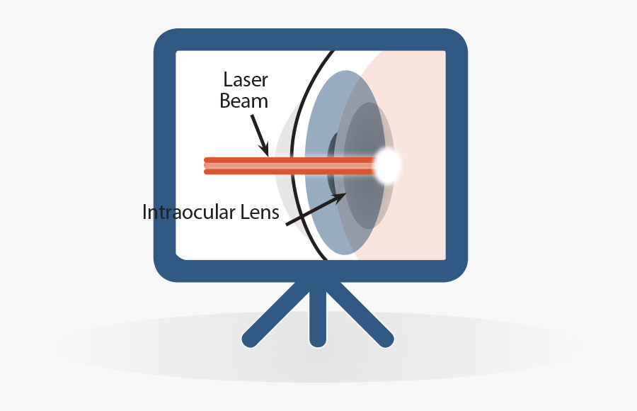 Secondary Cataract Pco Posterior Capsule Opacification - Circle, Transparent Clipart