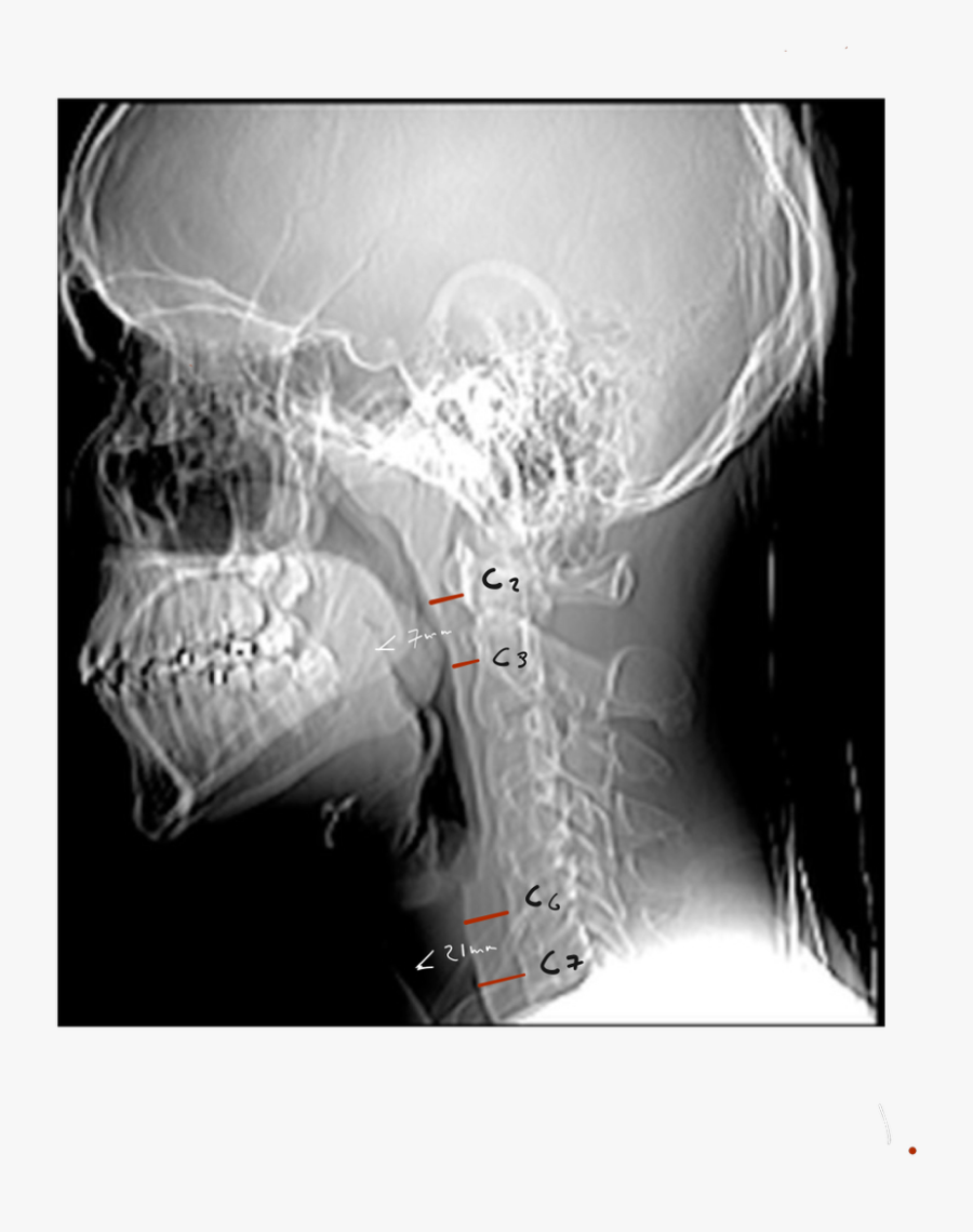 Clip Art Normal Neck X Ray - Radiology, Transparent Clipart