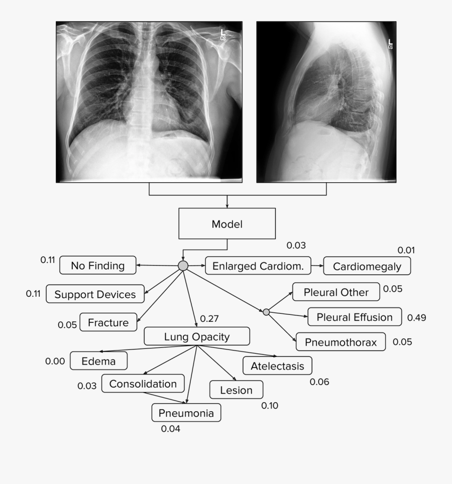 Xray Drawing Rib - Chest Radiograph, Transparent Clipart