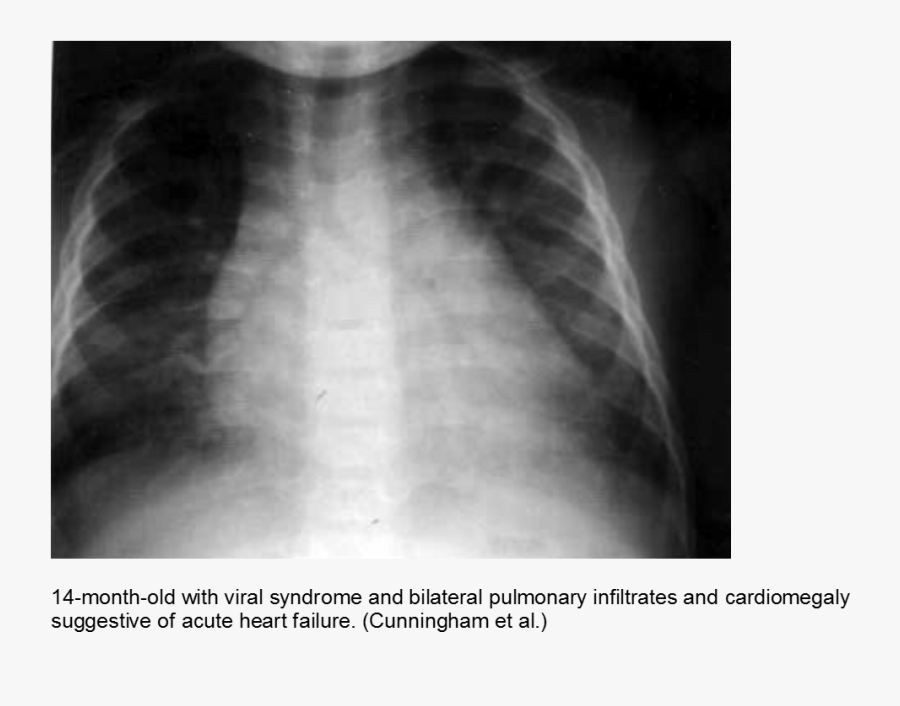 Xray Drawing Paediatric Pediatric Chest X Ray Myocarditis , Free