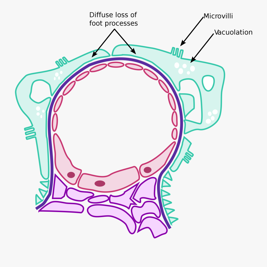 File Minimal Change Disease Pathology Diagram Svg - Minimal Change Disease Pathology, Transparent Clipart