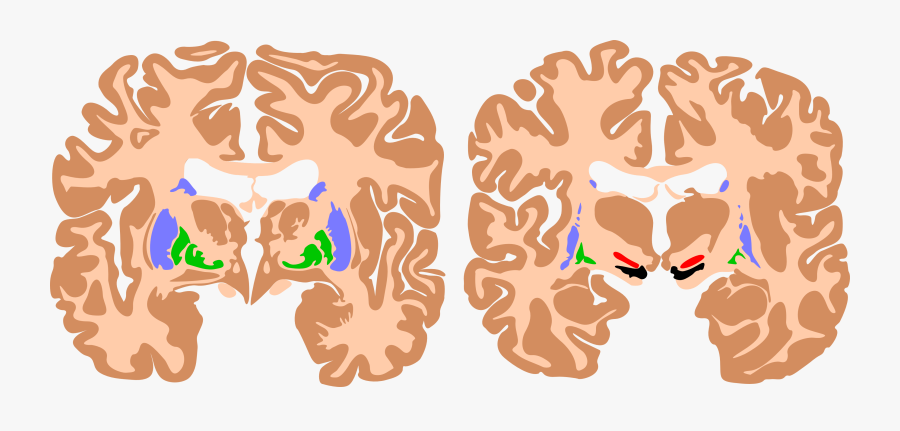 Basal Ganglia - Spastic Cerebral Palsy Brain, Transparent Clipart
