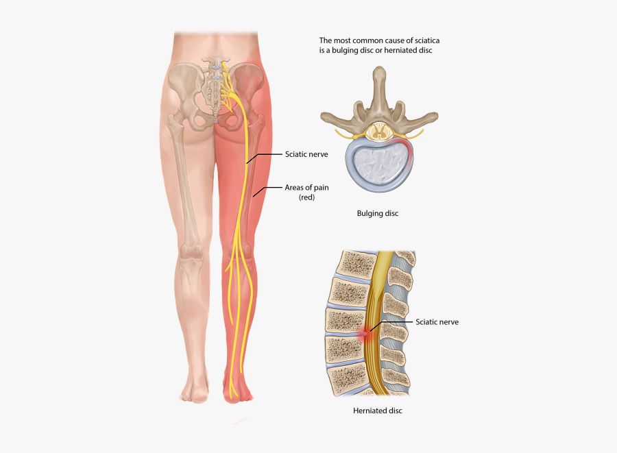 Clip Art Sciatica Leg Pain Treatment - Leg Burning, Transparent Clipart