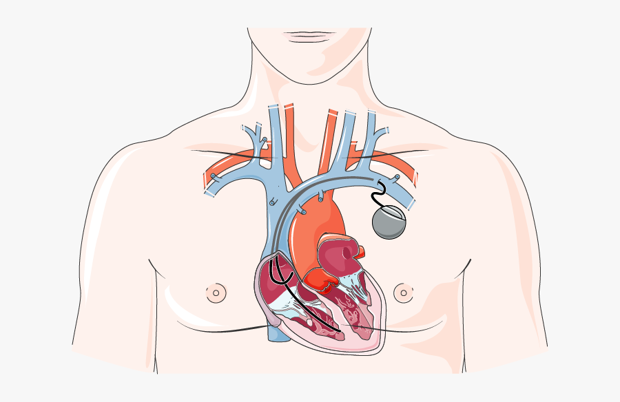 Pacemaker - Operation Pacemaker, Transparent Clipart