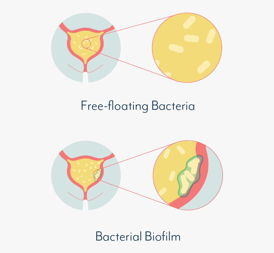 Kidney Clipart Uti - Chronic Urinary Tract Infection, Transparent Clipart