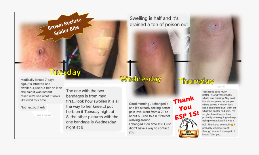 Esp 15 Used On A Brown Recluse Bite - Scar, Transparent Clipart