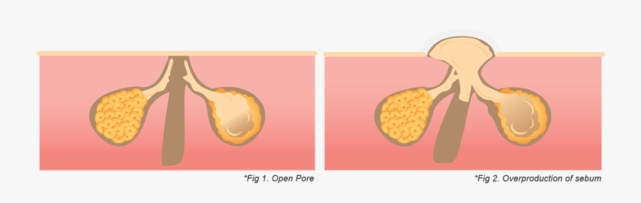 Acne Scars Graphic - Illustration, Transparent Clipart