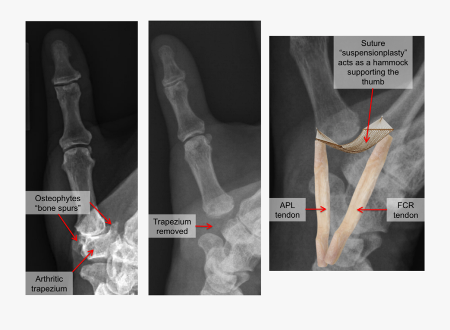 Clip Art Normal Hand X Ray - Radiography, Transparent Clipart