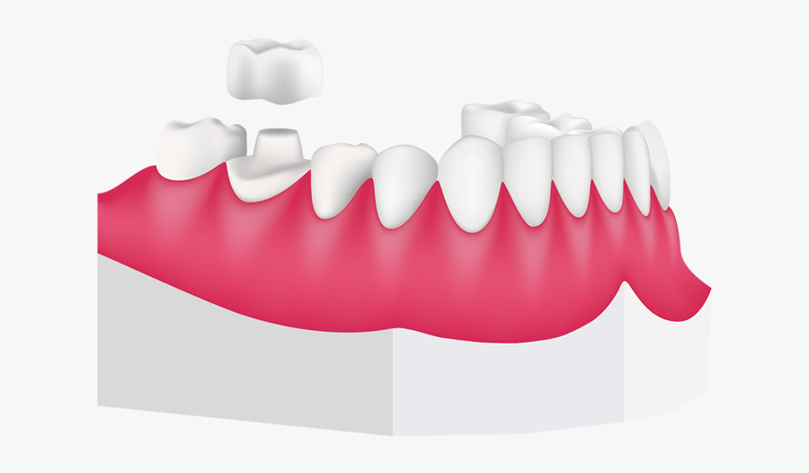 Dental Crowns For Children - Crowns On Children's Teeth, Transparent Clipart
