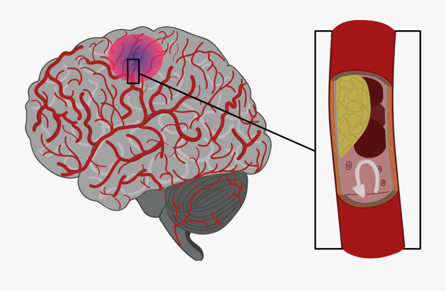 Uzaver Tepny - Brain Stroke Png, Transparent Clipart