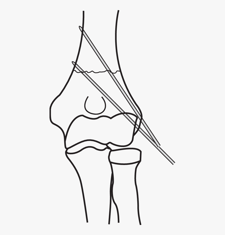 Coronal Line Drawing Demonstrating Ideal Divergent - Line Art, Transparent Clipart