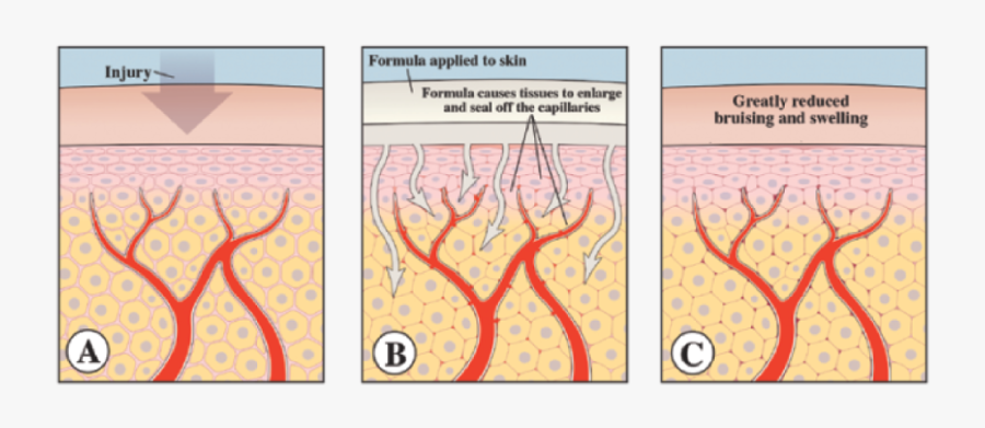 Bruise Repair Formula - Bruises How They Are Formed, Transparent Clipart