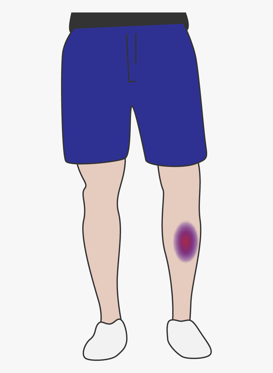 Collection Of Free Bruising Clipart Knee Download, Transparent Clipart