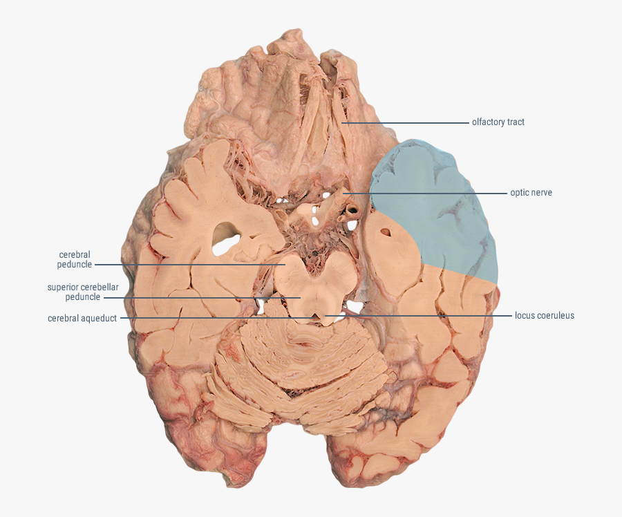 Middle Cerebral Artery Horizontal - Brain Mca, Transparent Clipart