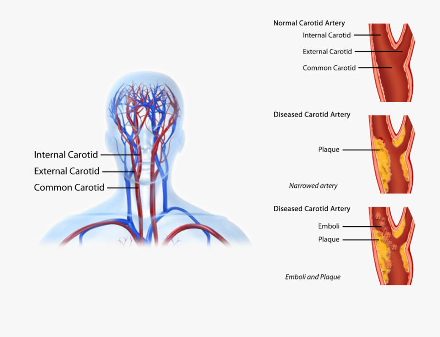 06 - Carotid Endarterectomy Cea, Transparent Clipart