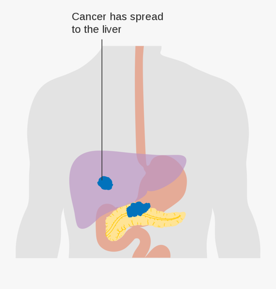 Pancreatic Cancer Spread, Transparent Clipart