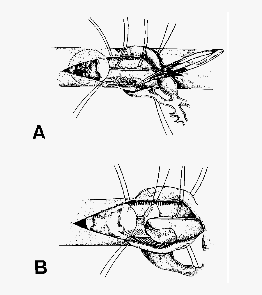 Semi Schematic View Of The Avulsion Reimplantation - Insect, Transparent Clipart