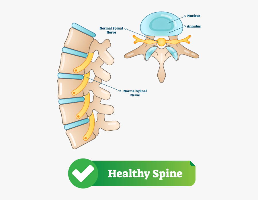Healthy Spine - Spinal Stenosis, Transparent Clipart