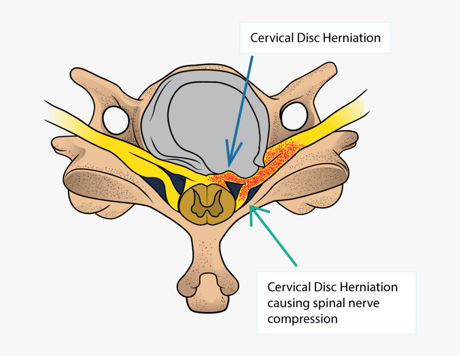 Cervical Disc Herniation And Cervical Radiculopathy - Cartoon, Transparent Clipart
