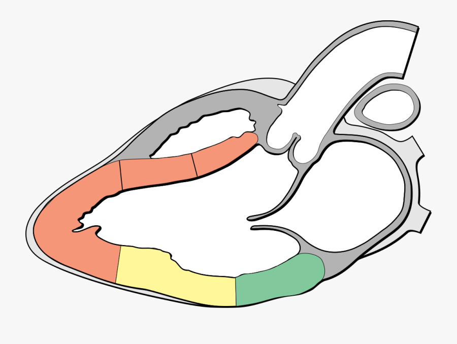 Mitral Valve Prolapse, Transparent Clipart